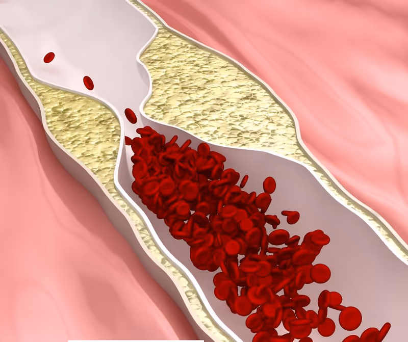 Cross-section of an artery showing plaque buildup and flowing red blood cells.