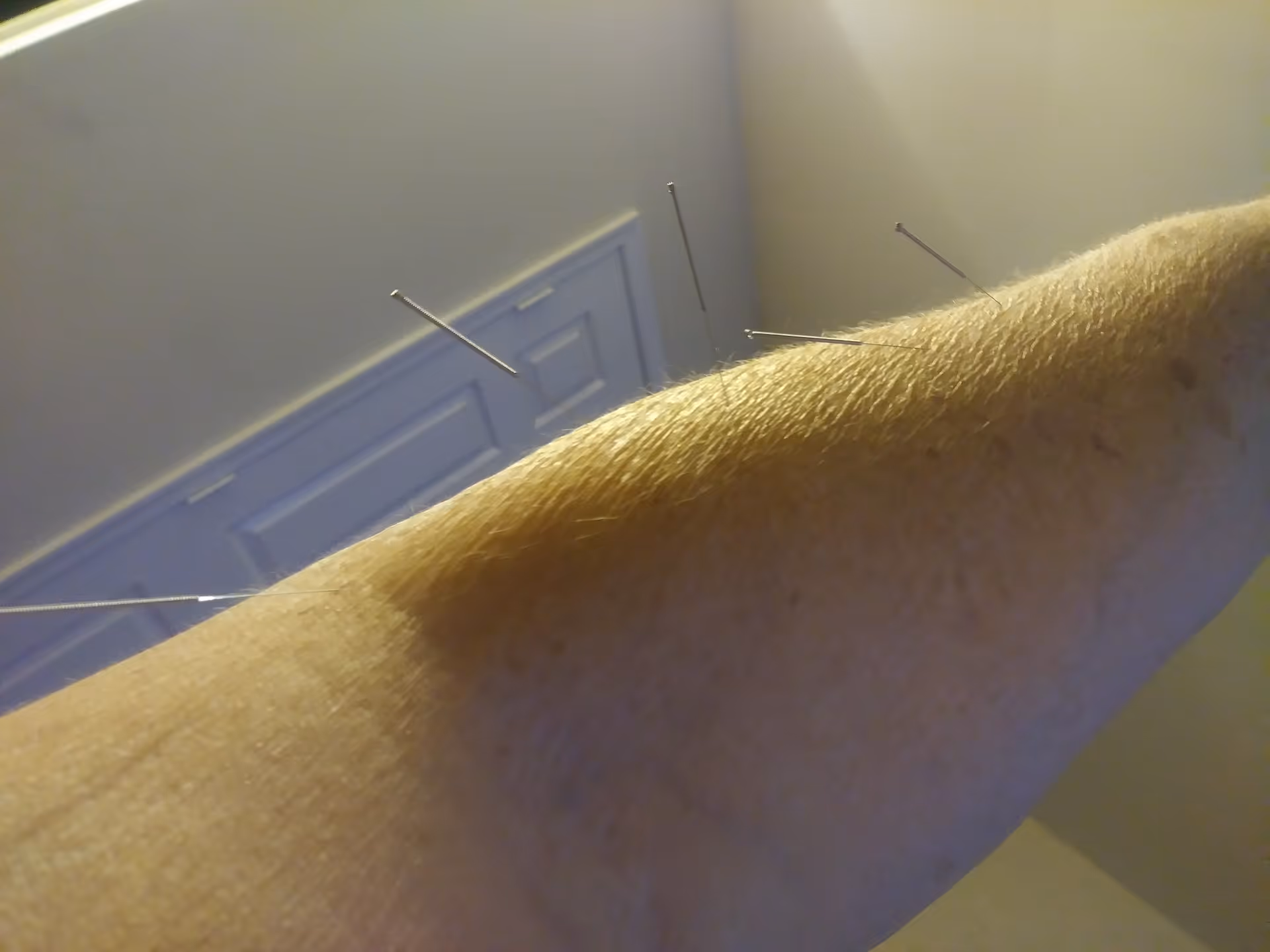 Close-up of an arm with multiple acupuncture needles inserted during treatment.