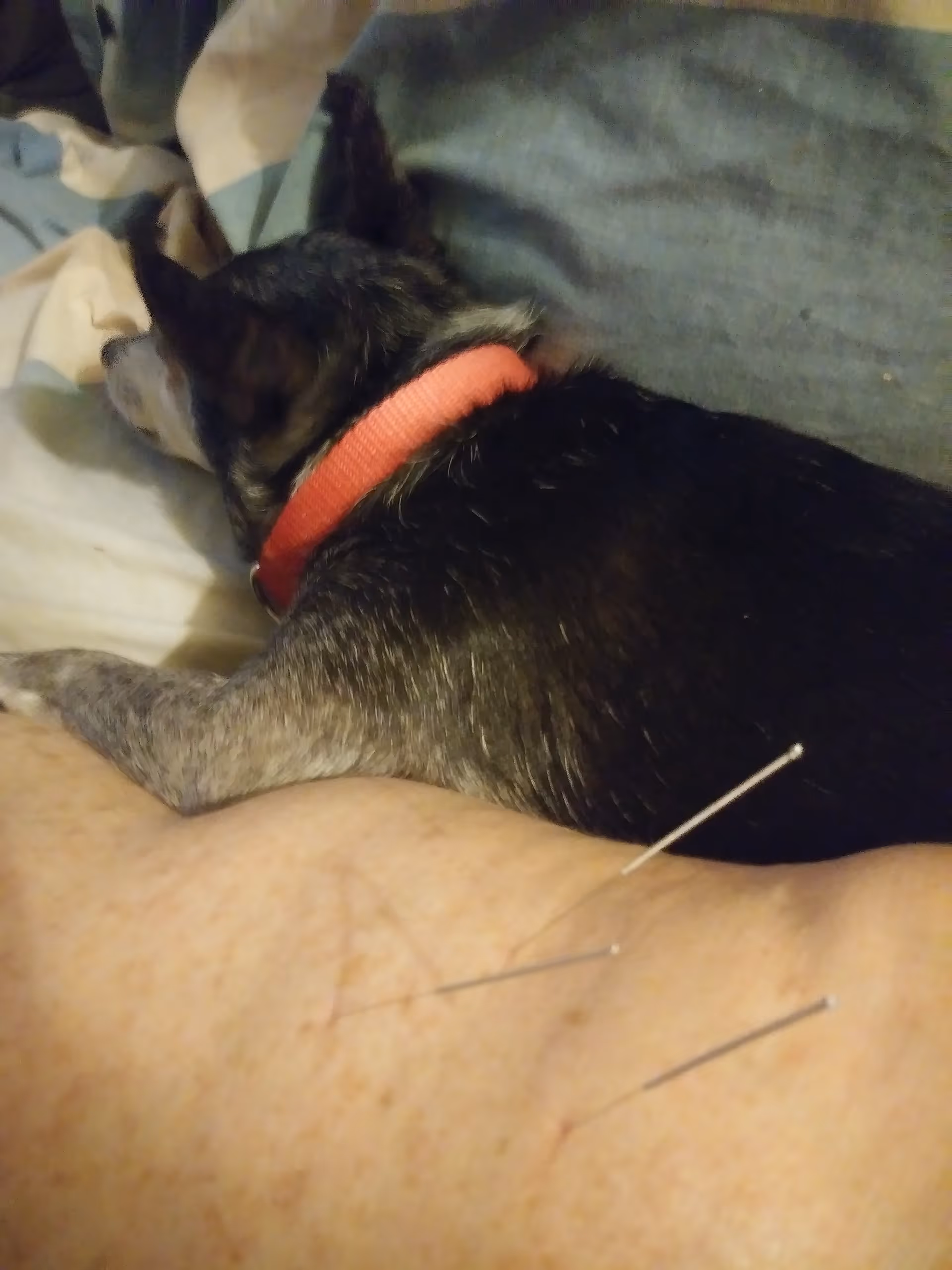 Close-up of acupuncture needles inserted into a senior patient's arm in bed.