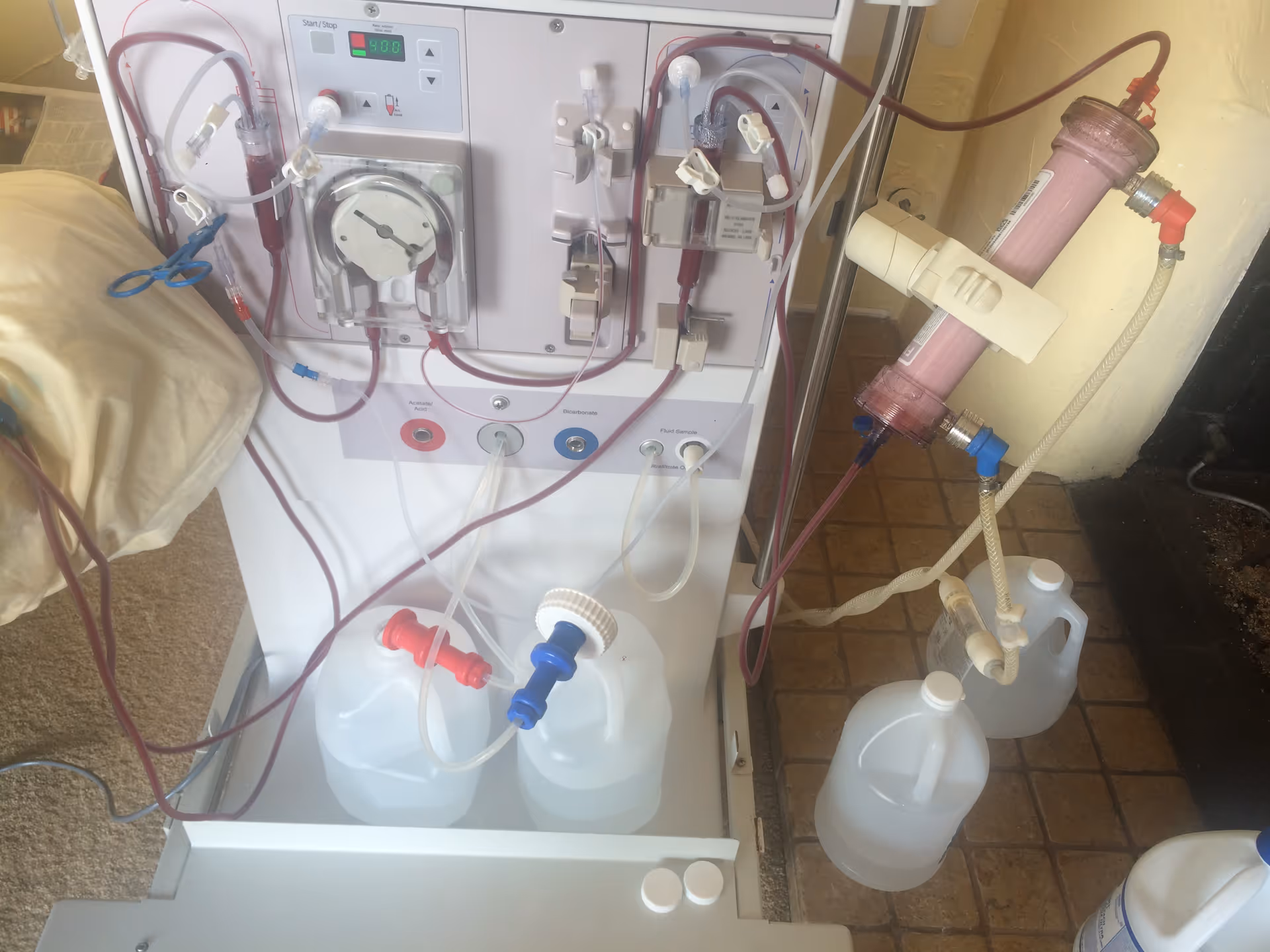 A medical dialysis machine with tubing and containers in a clinical interior.