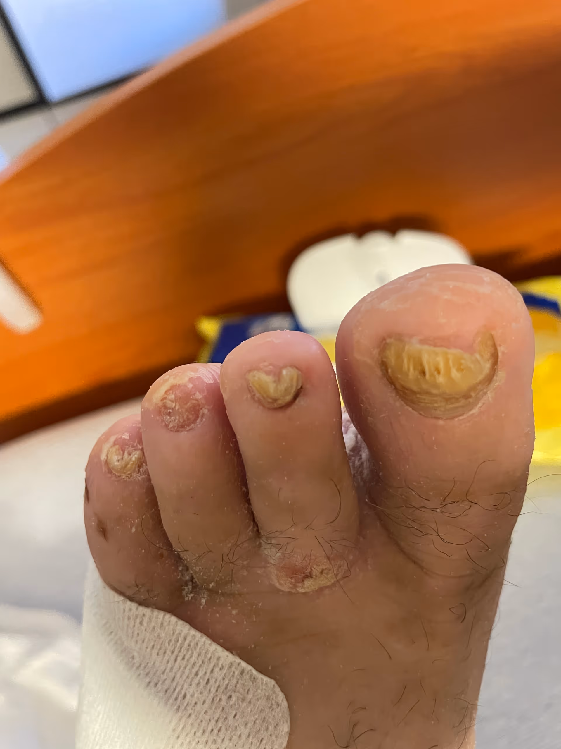 Close-up of a foot with thick yellowed nails and a bandaged big toe