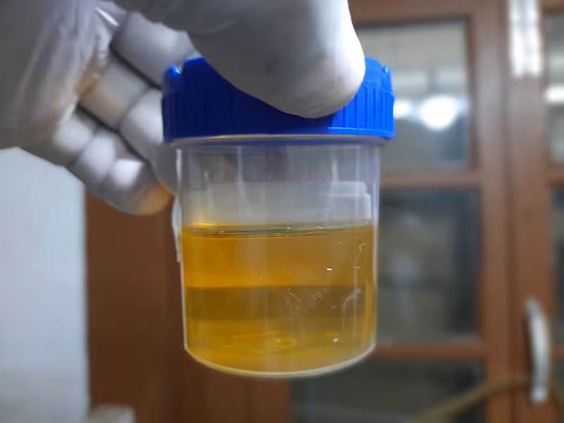 Gloved hand holding a urine sample container in a clinical interior.