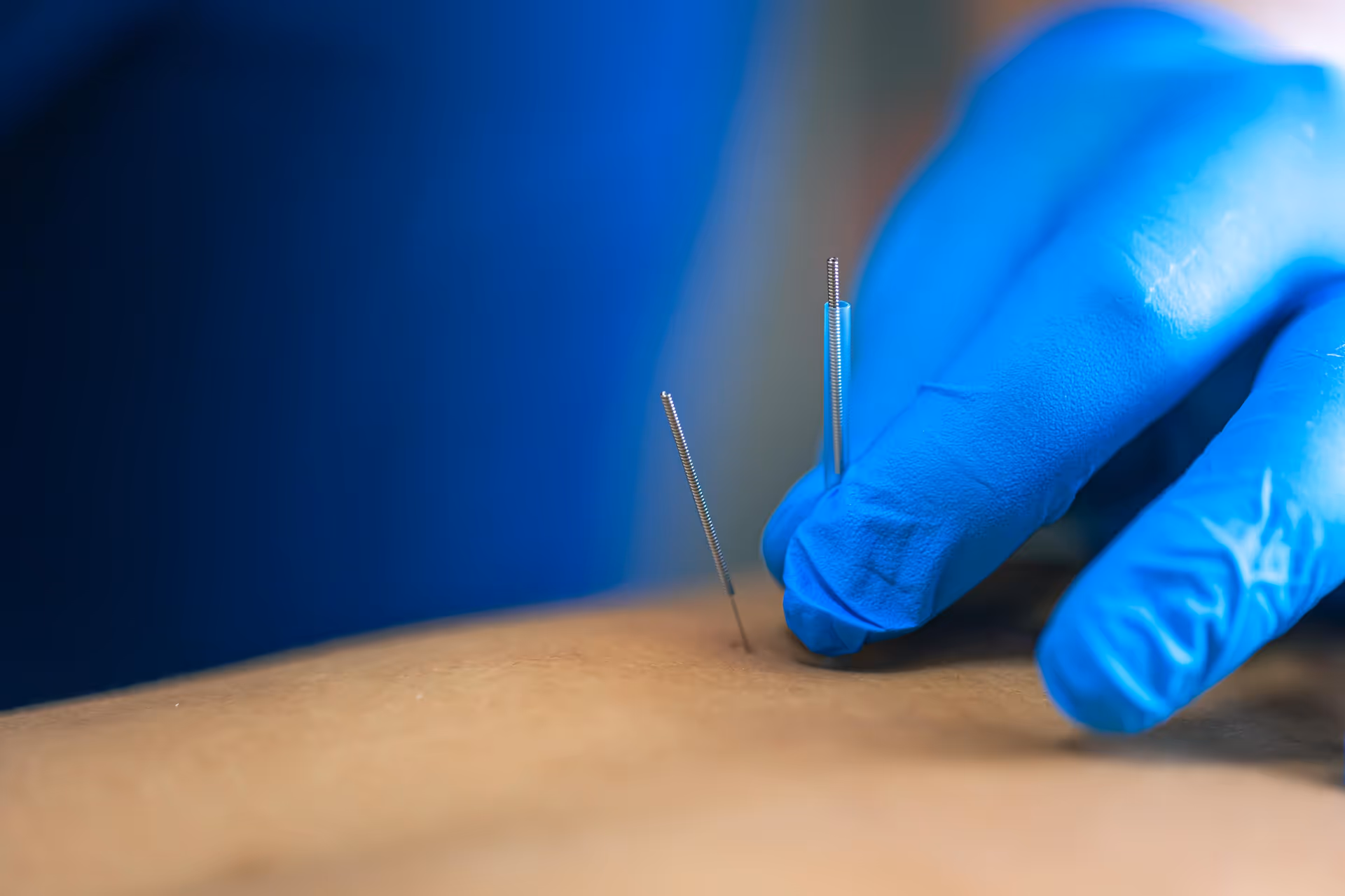 Close-up of gloved hand inserting acupuncture needles into skin.