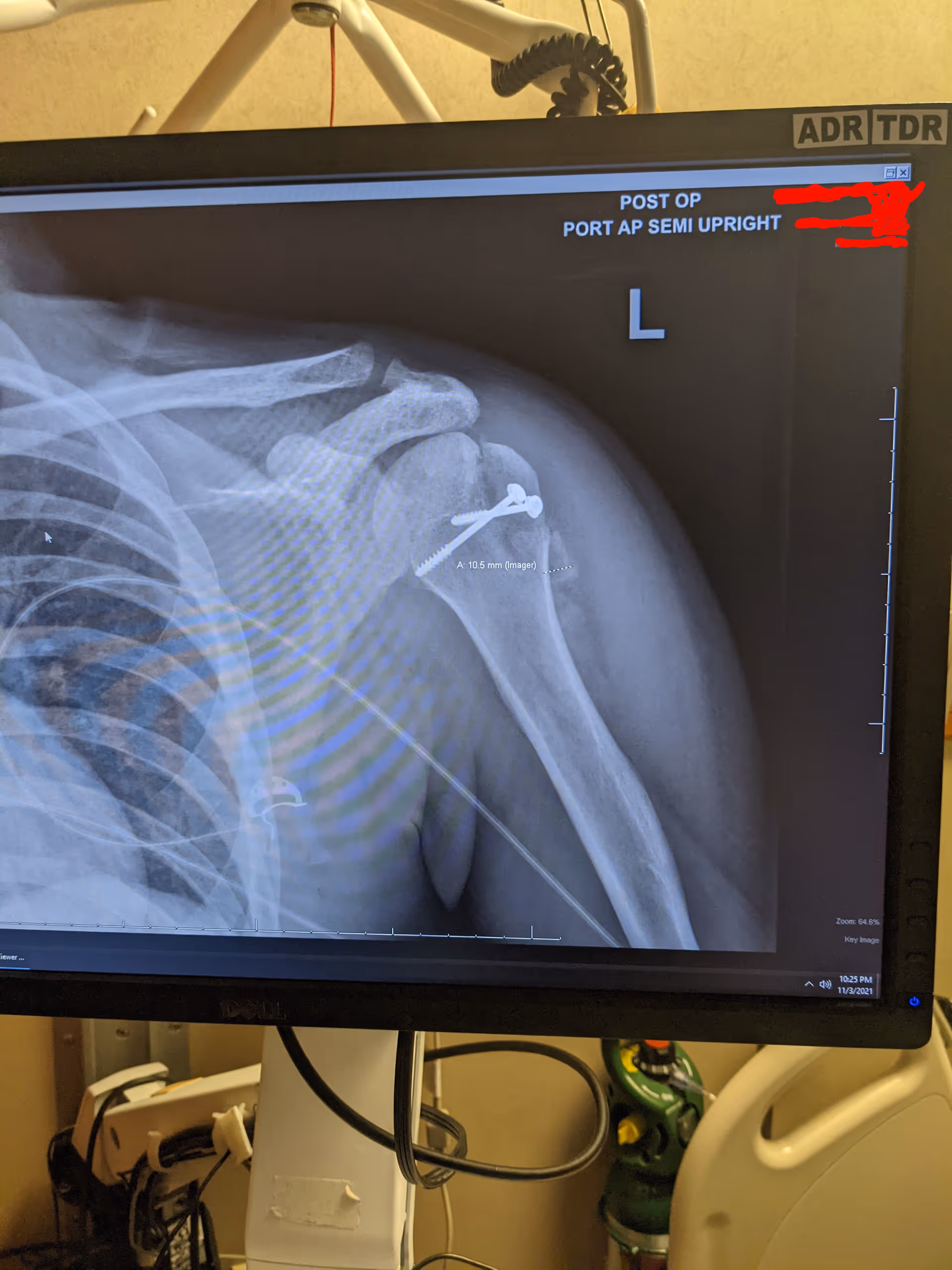 Shoulder X-ray displayed on a monitor in a hospital imaging room.