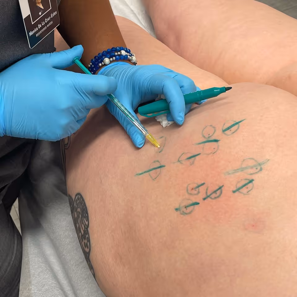 Gloved clinician marks a patient's skin with a marker during a cosmetic procedure.