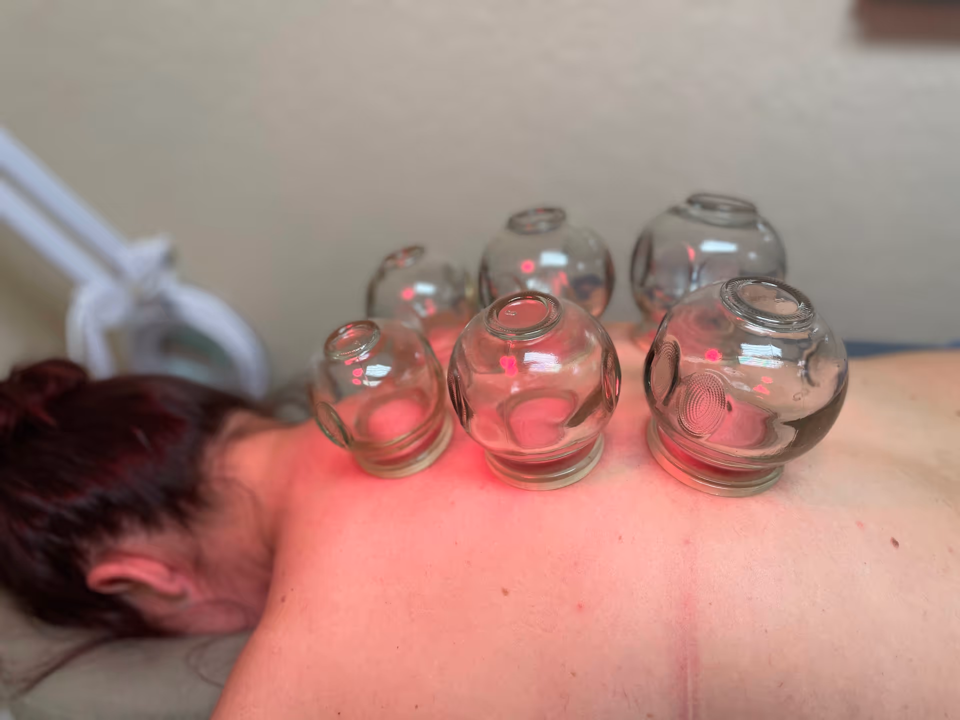 Cupping therapy with glass cups placed on a person's back.