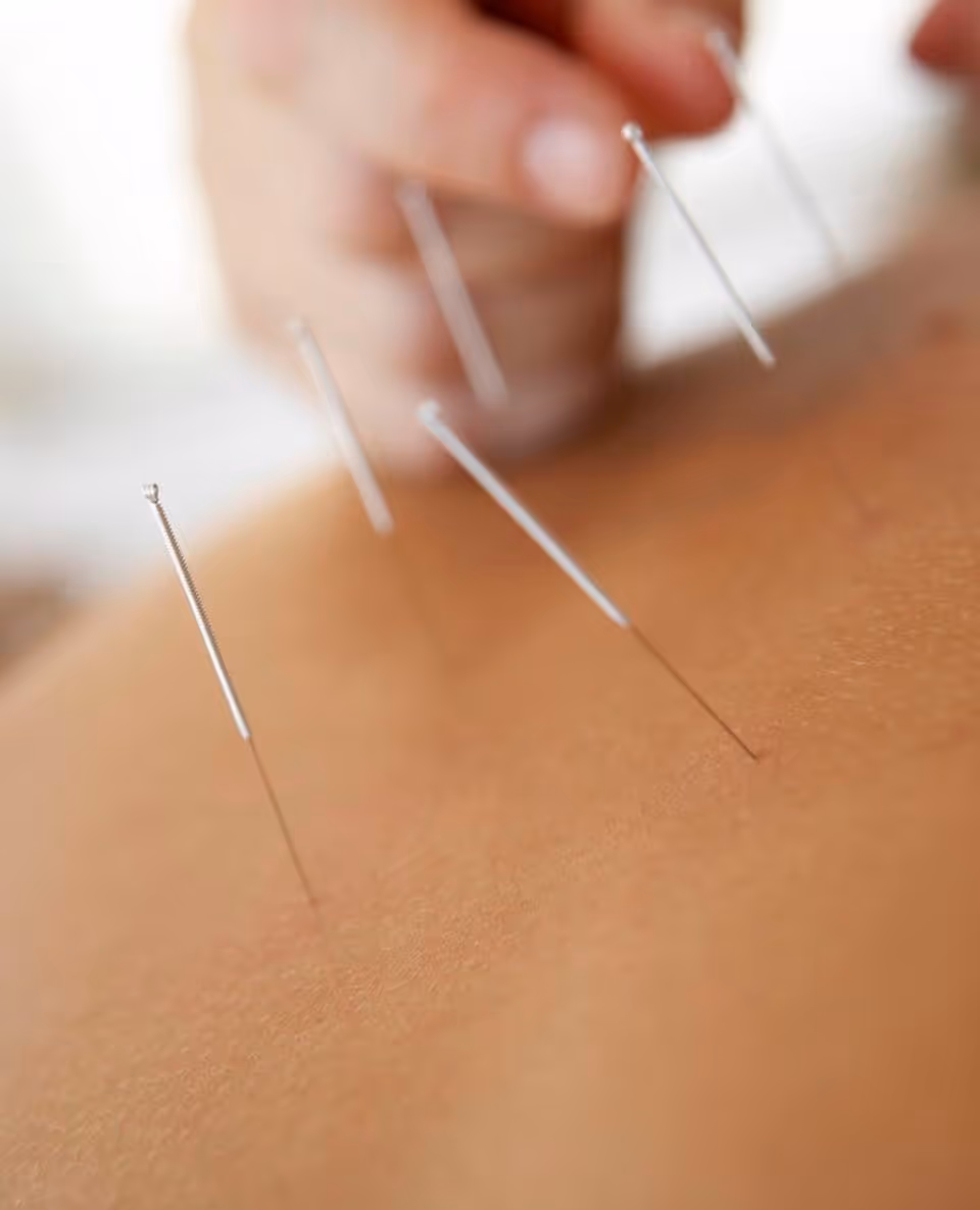 Close-up of acupuncture needles inserted into a person's back during treatment.