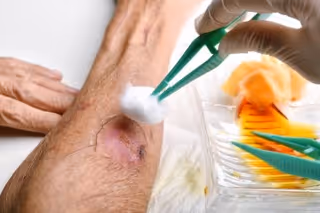A clinician in gloves treats a leg wound with cotton and tweezers.