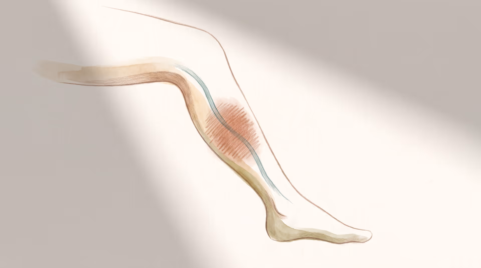 Deep Vein Thrombosis