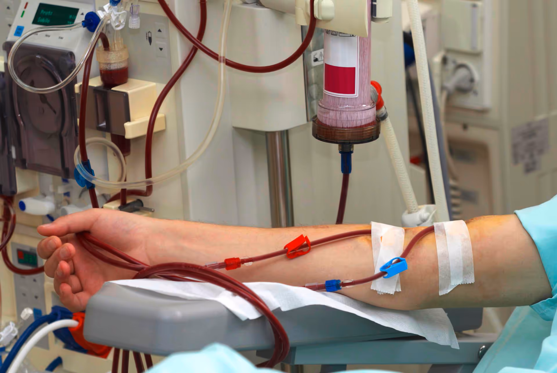 Arm with IV lines connected to medical equipment in a hospital setting.